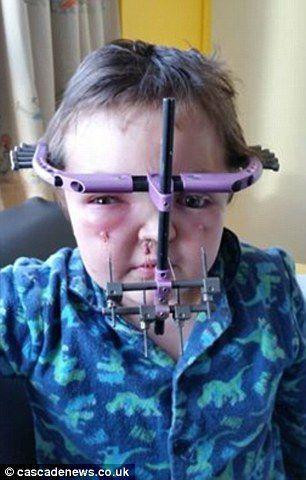 克鲁宗综合征(crouzon syndrome)引发的头骨过早融合,不但令沃德外观